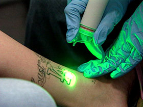 Tattoo removal