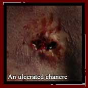 an ulcerated chancre